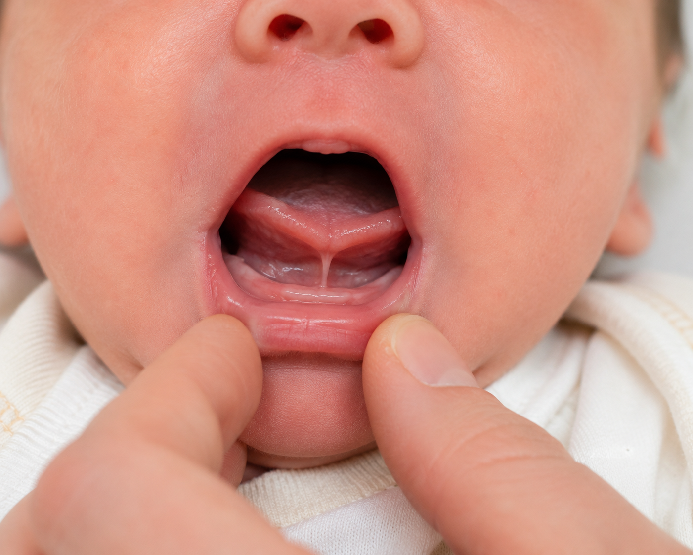Tongue tie support Cheshire & Shropshire